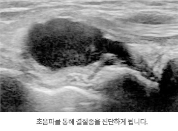초음파를 통해 결절종을 진단하게 됩니다.