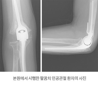 본원에서 시행한 팔꿈치 인공관절 환자의 사진