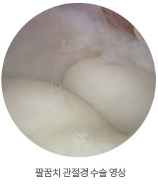 팔꿈치 관절경 수술 영상