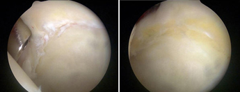 피부를 절개하여 관절을 노출 시킨 뒤 관절와순을 봉합하는 방법